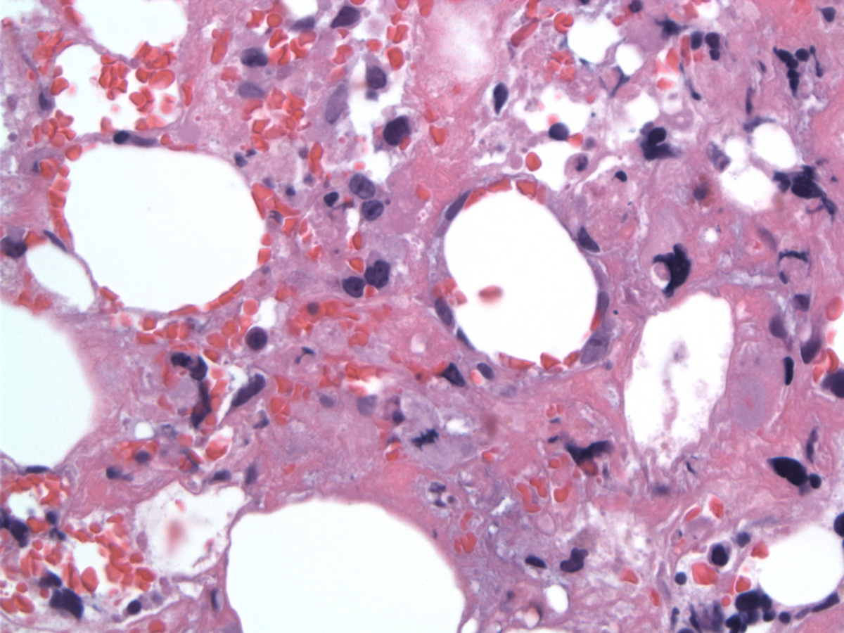 Medium-sized lymphoma cells